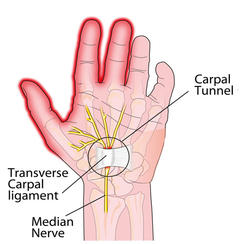 Carpal Tunnel
