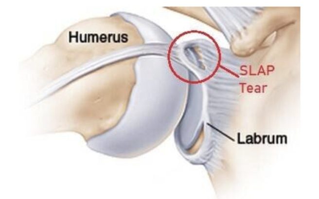 Shoulder Labrum Tear