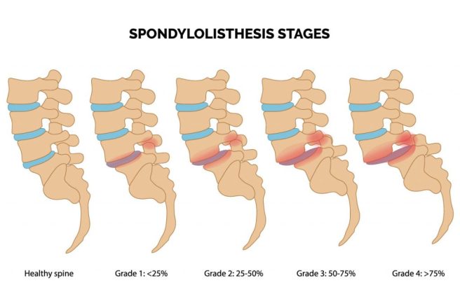 spondylolisthesis